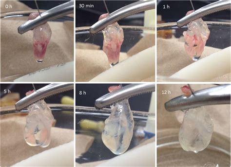 Cancer in the head of the pancreas cause symptoms like weight loss, yellowing of the skin, dark urine, light stool color, itching, nausea, vomiting. Picture of the pancreas during decellularization over 12 ...