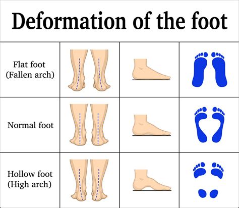 Talking about the english language proficiency tests, one must aware of ielts, toefl, and pte. How to fix Flat Feet