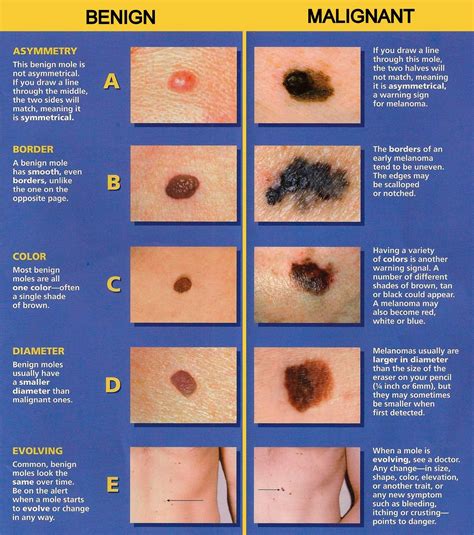 What will happen at my appointment? Melanoma: How do you know if a mole is dangerous? - Carenity