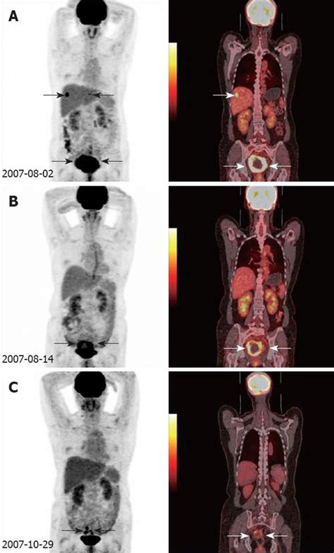 Any exposure to radiation carries a very small risk of potential tissue damage that could cause cancer at a later date. Peritoneal cancer pet scan PET/CT pentru Cancer ...