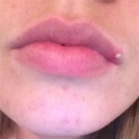 Sie sitzen überwiegend im mundwinkel oder unmittelbar am rand der lippe. Ist das ein Pickel auf der Lippe oder eher Herpes? (Eiter)