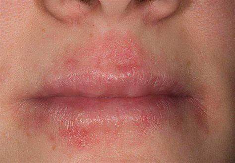 Дерматит симптомы диета Дерматит атипичный: фото, лечение, симптомы, причины, диета Дерматит атипичный: фото, лечение, симптомы, причины, диета Дерматит симптомы диета