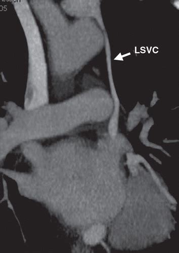 Tineke willems and marieke hazewinkel. Imaging of the Coronary Sinus: Normal Anatomy and ...