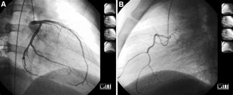 The incidence of prinzmetal angina is much lower then 50 years ago for many reasons including treatment with calcium channel blocks to treat hypertension and ischemia heart disease and the decrease of keywords: Prinzmetal Angina in an Adolescent | Circulation