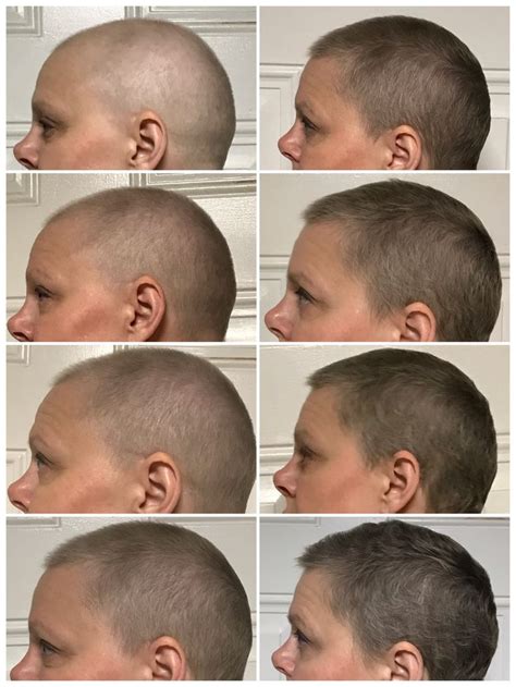 Check spelling or type a new query. After chemo hair growth. Weeks 1-8 | Hair growth after ...