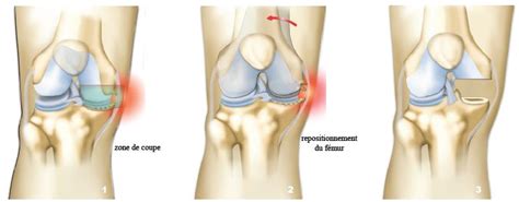 Image de planification 3d sur ordinateur permettant d'obtenir des instruments sur mesures adaptés à chaques patients. Chirurgie Arthrose Genou : Arthrose Genou | Douleur de Genou