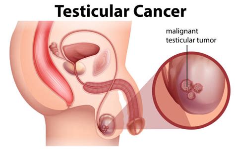 Your doctor will give you a physical exam and ask about your medical history. Testicular Cancer Illustrations, Royalty-Free Vector ...