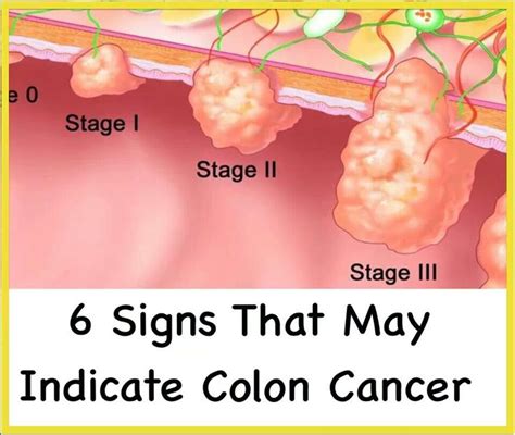 Chronic or frequent bouts of constipation, with the dog taking a long time to pass stools and straining and potentially, showing signs of pain when having a bowel movement. Colon Cancer | Posters | Pinterest