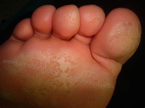 Cheratolisi punctata plantare erosiva e sudorazione ai piedi