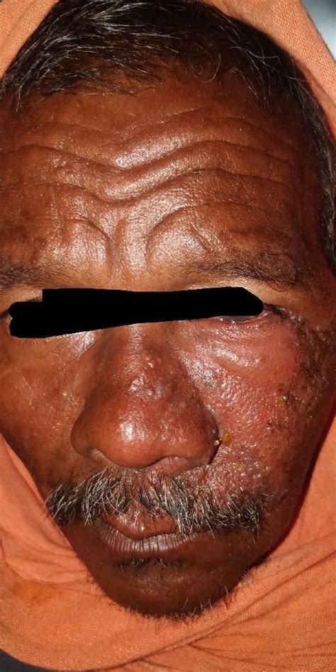Moving from the epidemiological to the clinical generate a renewed picture of a frequent disease that has per se a very relevant impact on. Herpes zoster opthamilcus