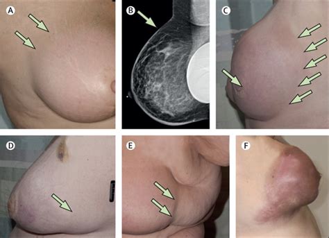 There are many types of skin cancer, each of which can look different on the skin. Inflammatory breast cancer: unique biological and ...