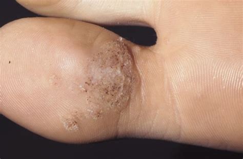 For recalcitrant warts, candida or mumps skin antigen can be injected into the wart every three to four weeks for up to three treatments. Combination Therapy Superior to Monotherapy for ...