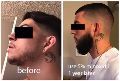 Minoxidil was initially used as a oral medication to reduce blood pressure. Minoxidil Before And After Beard Result - Minoxidil For ...