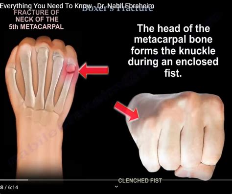 Check spelling or type a new query. Boxer's Fracture — OrthopaedicPrinciples.com