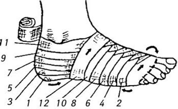 Вторая повязка более удобна для пациента и более наилучшим примером является колосовидная повязка на плечо, которая наносится после. Повязки на нижние конечности - Хирургия