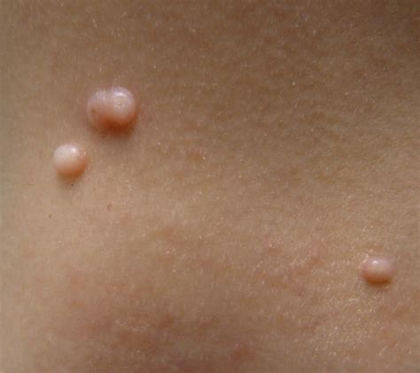 Molluscum contagiosum, commonly called as water warts, is a viral infection. Condyloma accuminata and other genital lesions due to ...