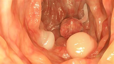 Colon cancer is the second deadliest form of cancer in the u.s., yet it doesn't have to be. Blood Streaked Stool - Stools Item