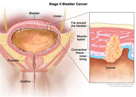First, transitional cell carcinomas are locally aggressive and it is. Bladder Cancer Treatment (PDQ®)—Patient Version - National ...