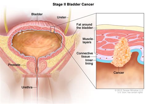 Dogs with bladder cancer are listed as being in stages 0 to 4. Bladder Cancer Treatment (PDQ®)—Patient Version - National ...