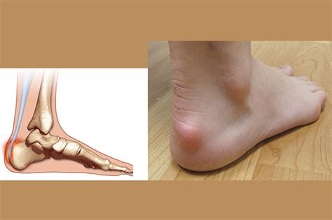 To be clear, the scientific literature does not yet describe if the bony protrusion/heel bump will resolve or regress if the irritating source (such as a. Heel Pain (Plantar Fasciitis) | Dr. Babajide A. Ogunlana ...