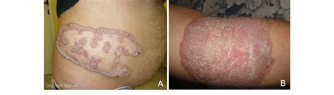 Abstract fonsecaea pedrosoi is a fungal pathogen that produces melanin. A Case one with abdominal lesion since 5 years due to F ...