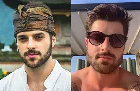 Lucas lima realizou um procedimento estético e compartilhou o resultado nas redes sociais. Antes e Depois de famosos que fizeram harmonização facial ...