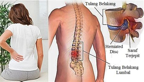 Kostokondritis yakni salah satu penyebab dari tulang dada yang merasa sakit serta salah satu penyebab yang paling sering terjadi. TBC Tulang: Gejala, Penyebab, dan Cara Mengobatinya ...