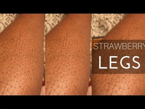 Now is the time for you to stop it in many natural and. Get Rid Of Strawberry/Chicken Legs In 2 Minutes. - YouTube