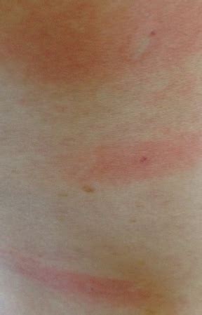 Medical removal is required only in rare cases. How I Removed Cherry Angiomas At Home | Cherry angioma removal, Tattoo cream, How to remove