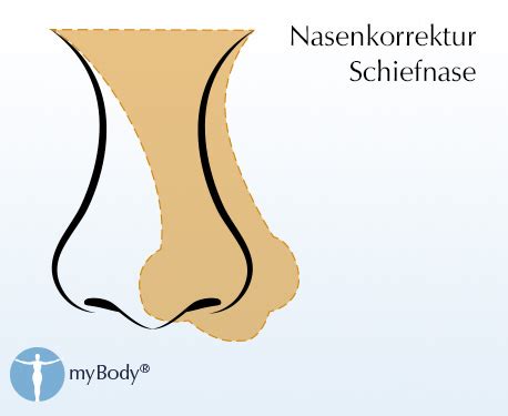 Nasenschmerzen > innen, wie wund. Nasenoperation Kosten - So viel zahlen Sie für eine ...