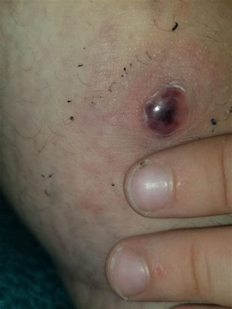 Ingrown hair pimple with pus on my thigh lol. Possible cyst? Ingrown hair? Bug bite?? You tell me what ...