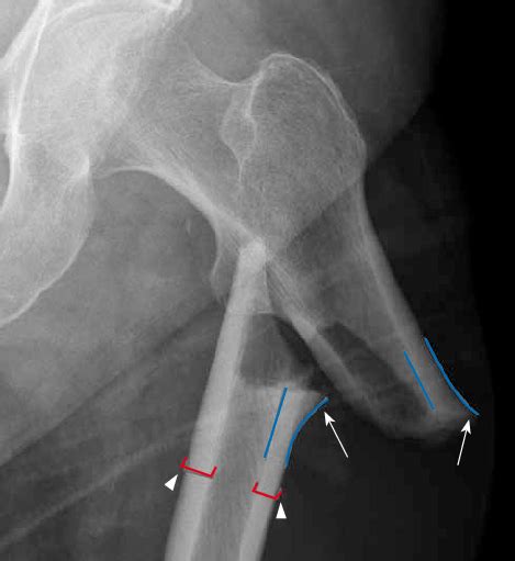 Typical pattern of an alendronate-associated femoral ...