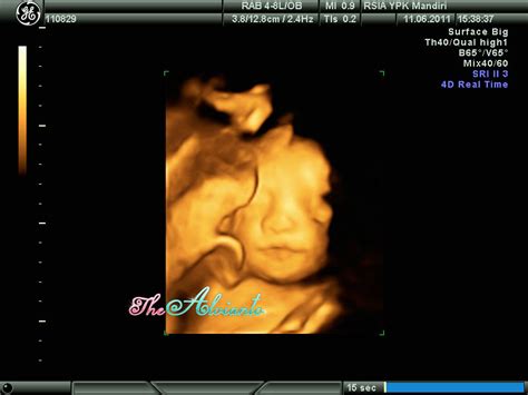 Selama masa kehamilan, biasanya perempuan akan melakukan pemeriksaan ultrasonografi atau usg, untuk mengatahui kesehatan dan perkembangan janin di dalam kandungan. Ukuran Janin 2 Bulan - Soalan aj