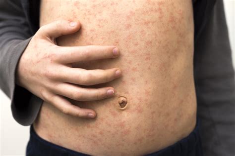 Resources for covid vaccine mandates. Coronavirus may trigger a measles resurgence as ...