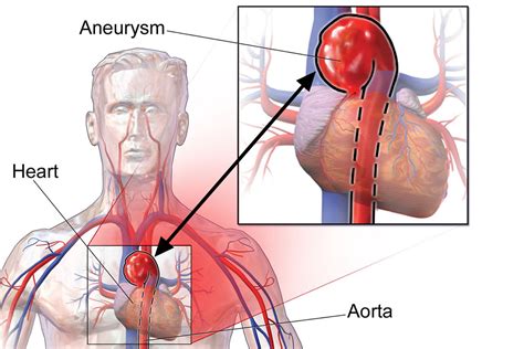 A family history of aneurysm may increase your risk for developing an aneurysm. Aortic Aneurysm - Abdominal & Thoracic - Causes, Symptoms ...