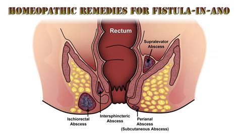 To choose the right surgery has been made more difficult, with new surgeries being added. Homeopathic Remedies for Fistula-In-Ano — Homeopathic ...