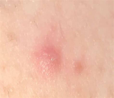 Infection could result from touching, scratching or popping with dirty tools and hands. Pretty sure this is an ingrown hair but anxiety is through ...