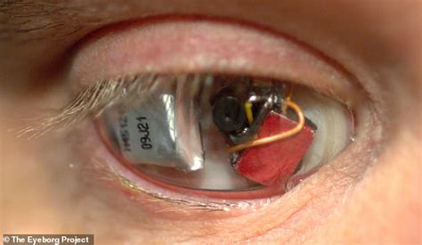 For all kinds of eyelid dermatitis, people should keep the eye area clean and avoid touching it or scratching. 'Eyeborg' filmmaker has a video camera in his prosthetic ...