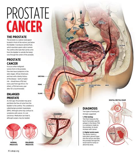 Whether prostate cancer is suspected based on screening tests or symptoms, the actual diagnosis is the grade of the cancer is based on how abnormal the cancer looks under the microscope. Cancer of the Prostate. Causes, symptoms, treatment Cancer ...