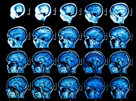 Estas neuronas transmiten mensajes desde el cerebro y la médula espinal hacia los músculos voluntarios, los que usted puede controlar, como los de los brazos y las piernas. 11 Claves para conocer mejor la esclerosis lateral ...