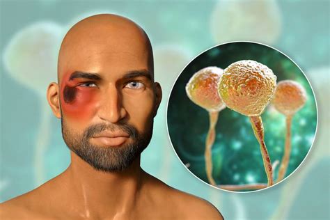 Los hongos que causan la infección son organismos ambientales comunes, generalmente hongo negro | un desafío mayor que el coronavirus: ¿QUÉ ES EL "HONGO NEGRO" Y CUÁLES SUS SÍNTOMAS? - BC ...