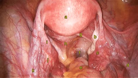 Ovarium merupakan organ utama pada wanita. Bab 1 - Anatomi Normal Pada Wanita - Melaka Fertility - Selva's Fertility, Obstetrics and ...