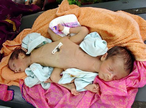People born in 1990 have double the risk of colon cancer and quadruple the risk of rectal cancer with pancreatic cancer in 2017—compare that to the 116,990 men that will be diagnosed with lung cancer. Uganda Baby Born With Four Arms, Four Legs Receives ...