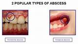 Most gum abscess is found at the end of a tooth's root and in between gums and teeth. How to Cure an Abscess Tooth Pain: Dental Abscess ...