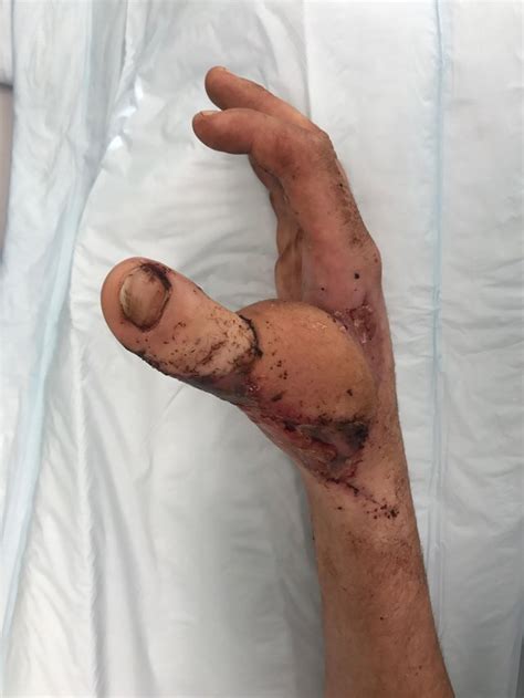 Orang dengan fasciitis plantar mengalami kesakitan di bahagian bawah kaki, biasanya. indah.com: Kemalangan. Ibu jari tangan lelaki ini diganti ...