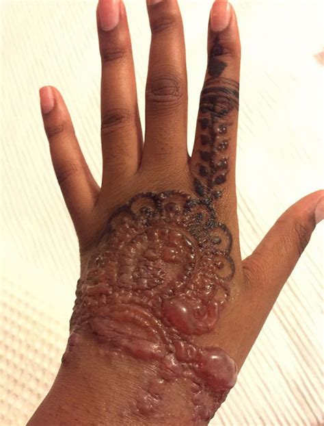 In spite of the risks, people with eczema can and do still get tattoos. The Extreme case of henna tattooing dermatitis - MEDizzy ...