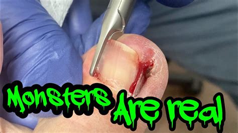 An ingrown hair happens when a hair that's been cut, shaved, or tweezed curls and starts growing back into the skin, rather than away from it. REMOVAL OF AN EXTREMELY PAINFUL INGROWN - YouTube
