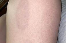 bruise thigh touched noticed she pushed diagnoseme
