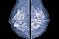 breast mammografia mammographie densa mamografia poitrine nhs getty mammaire thermografie vergleich termografia confronto comparaison thermographie young farage nigel labour ultrassom