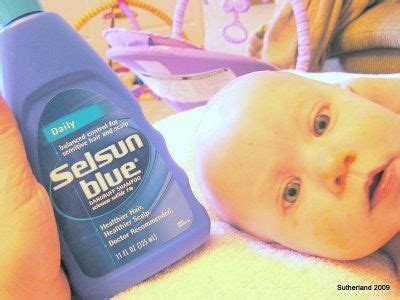 cradle cap tips--DO NOT recommend this. the selsun blue ...